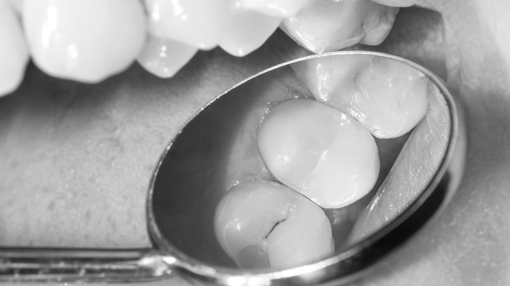 White Fillings Headington, Composite Fillings Oxford