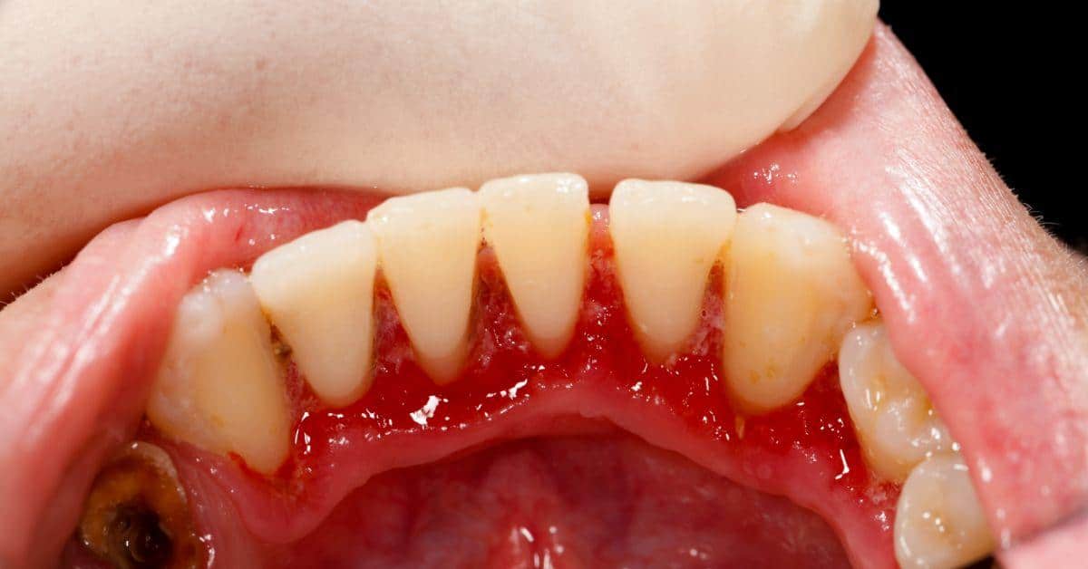 How Long Can You Keep Your Teeth With Periodontal Disease: A 